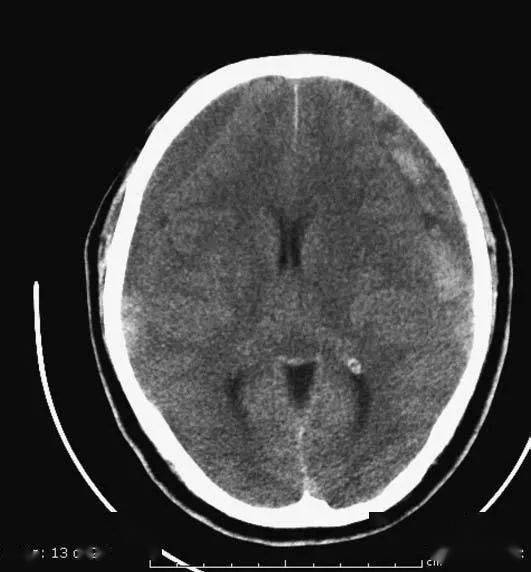 外伤性蛛网膜下腔出血:脑沟,脑池内可见高密度影▲额叶及颞叶脑挫伤