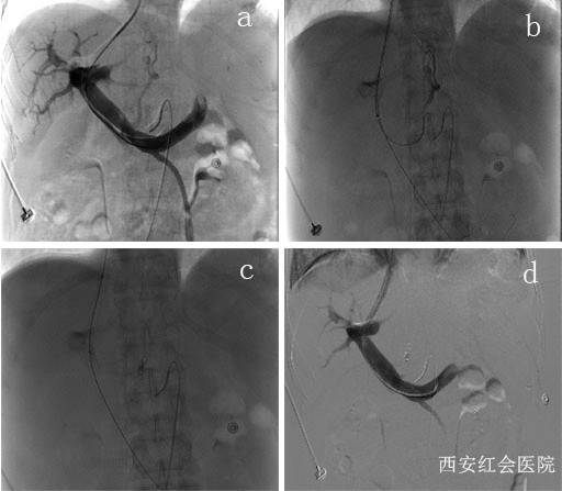 治疗|西安市红会医院消化内科介入组内完成两例TIPS手术