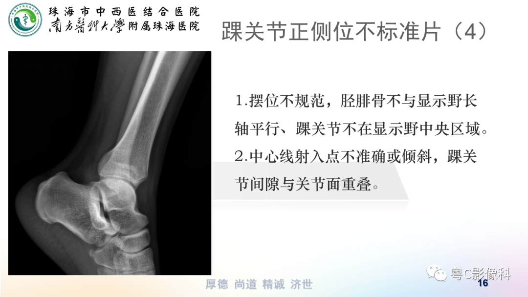 踝关节dr摄影技术分享