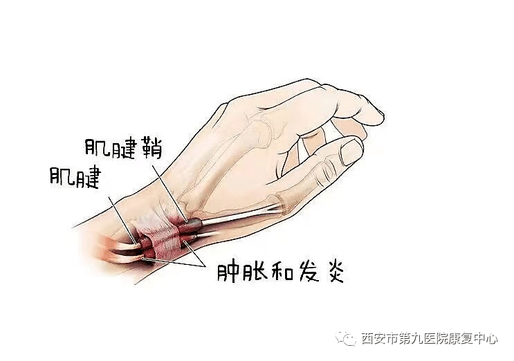 手腕腱鞘炎以前只是中老年女性的常见病,与中老年人做家务劳动多