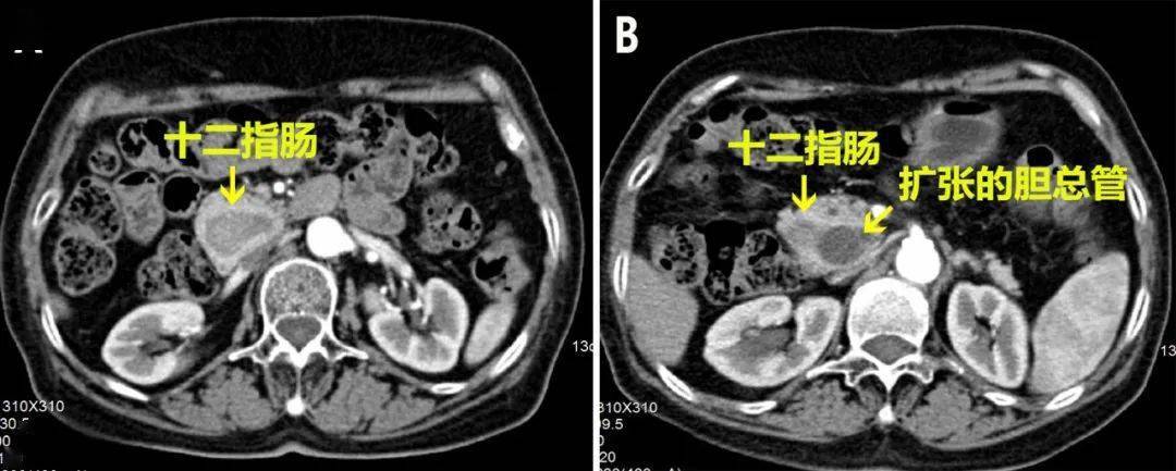 "胰腺占位"竟是它_造影_环状_万女士