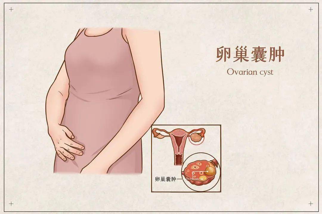 女生生气后果有多严重卵巢囊肿竟然是气出来的