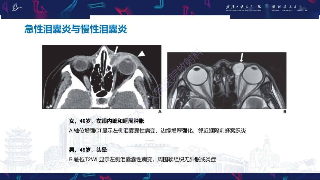 泪道病变影像诊断