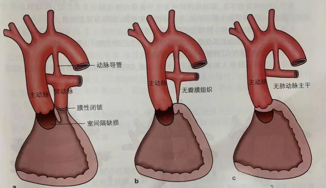 室间隔缺损合并肺动脉闭锁的胎儿超声心动图诊断