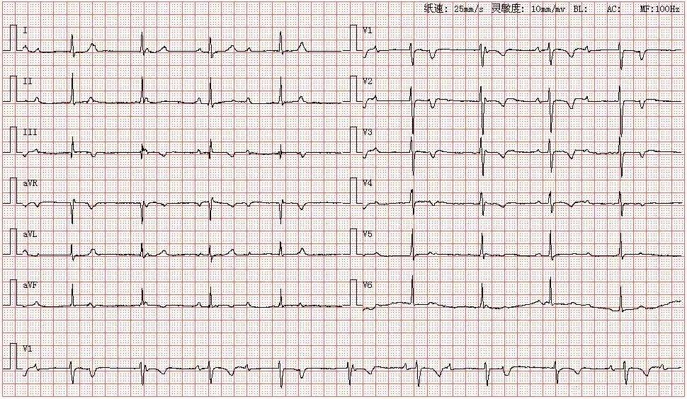心电图图谱 3如图所示,p波在在,avf,v4-v6导联直立向上,avr导联