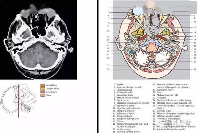 视神经 11.蝶窦 12.蝶骨 13.颞下回 14.眶上组织 15.三叉神经 16.