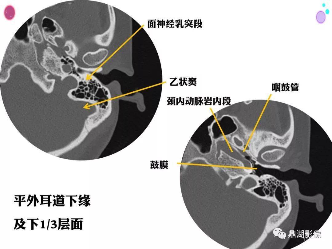 【收藏】史上最全的ct断层解剖图谱_大脑_小脑_动脉