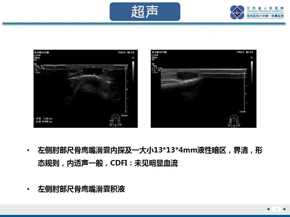 结节性筋膜炎影像表现