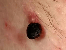 丝状疣确实是由人乳头瘤病毒(hpv)感染引起的,常见于免疫力低下的人群