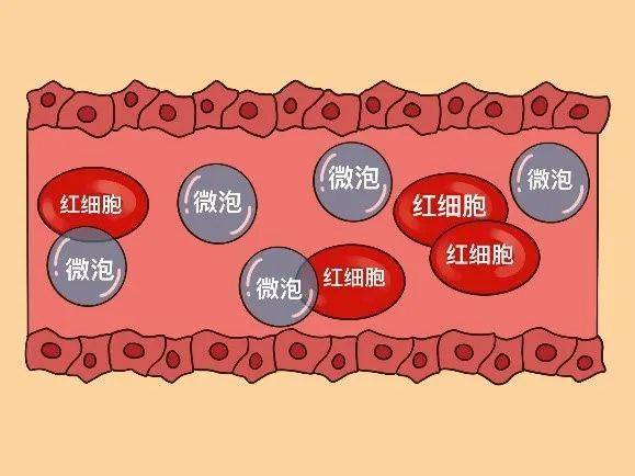 目前临床广泛应用的超声造影剂为微气泡,大小与血液中红细胞相仿,粒径