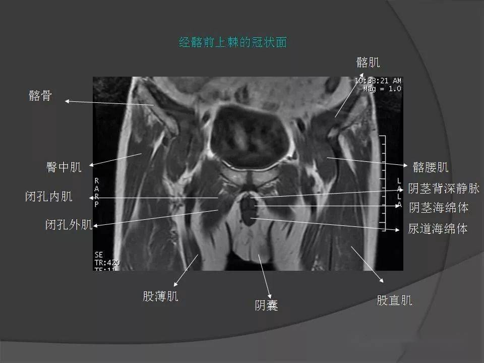 骨盆肌肉解剖mri标识