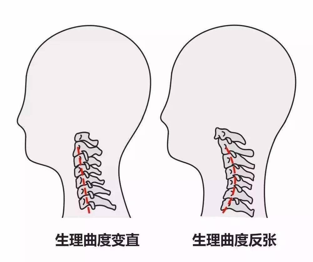 通过这三点纠正反曲的颈椎