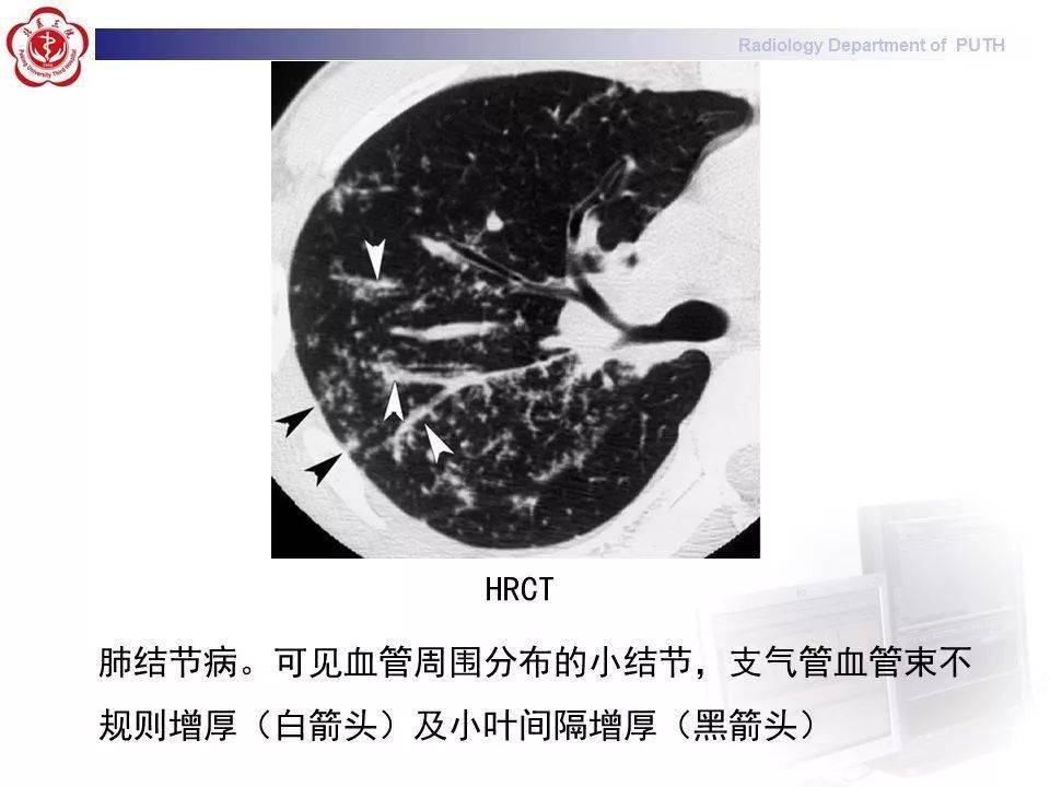 结节病的影像表现