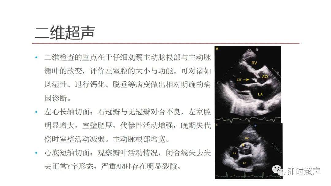 主动脉瓣狭窄及关闭不全