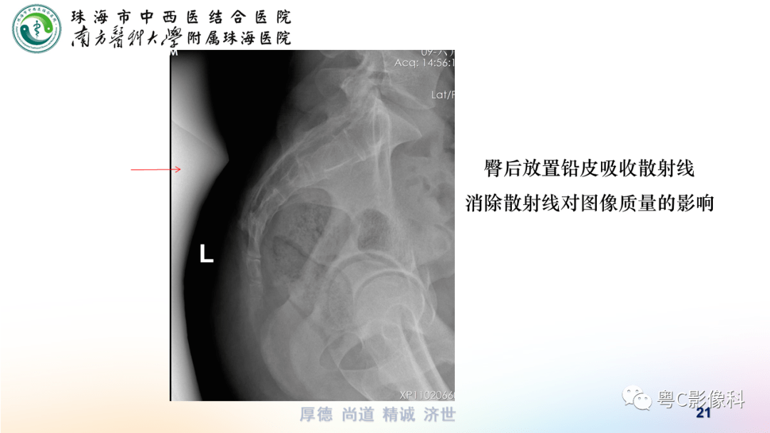 基础巩固:骶尾骨正侧位x线摄影_诊断_结构_肿瘤