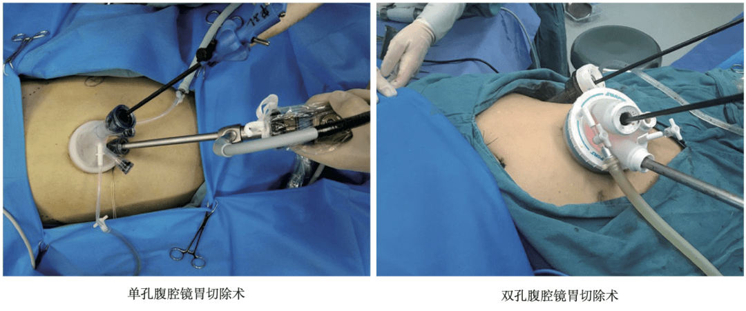 《腹腔镜胃肠手术笔记(第二版)》新书抢先看_网膜_淋巴结_结肠