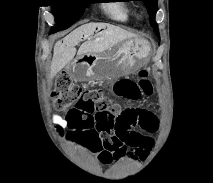 胃炎(gastritis)是各种原因(酒精,幽门螺杆菌,非甾体抗炎药等)引起的