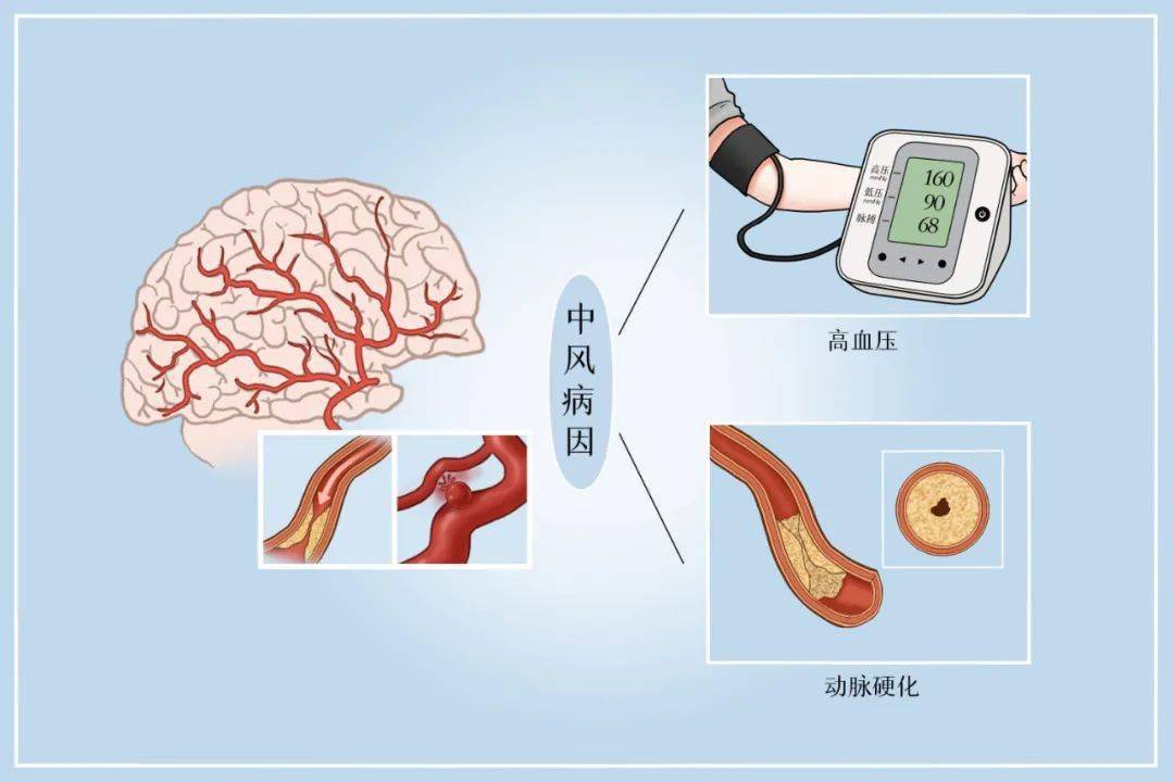 【迁医健康】急症脑卒中的症状和救治,学到它,能救人_患者_进行_治疗