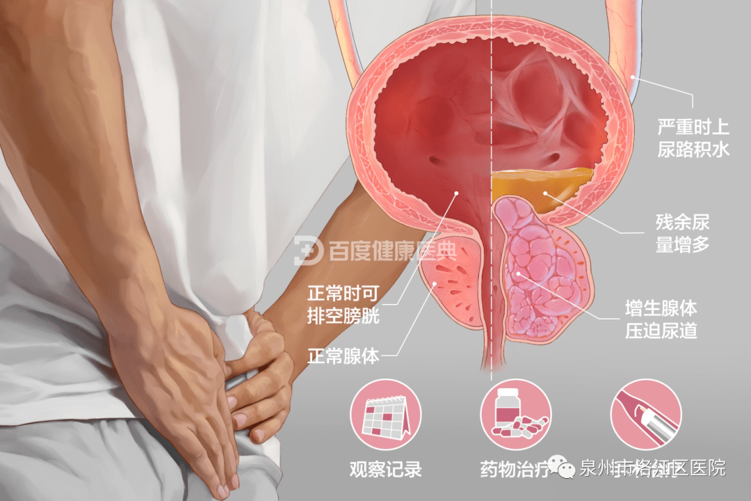 前列腺增生典型症状:储尿期症状:尿频,尿急,夜尿增多以及急迫性尿失禁