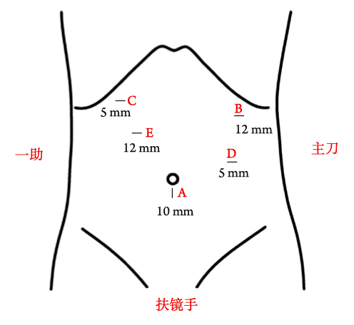 0 kpa,置入直径为10 mm的trocar作为观察孔(a,开腹取标本时沿此切口