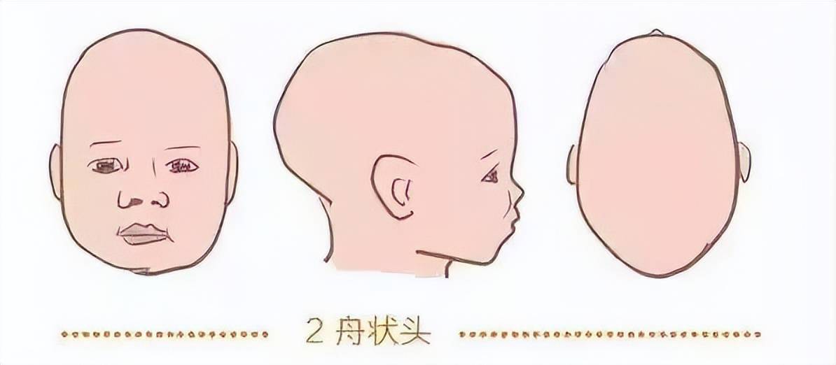 新生儿这个病被耽误到3岁,不得不做开颅手术_可可_头型_宝宝