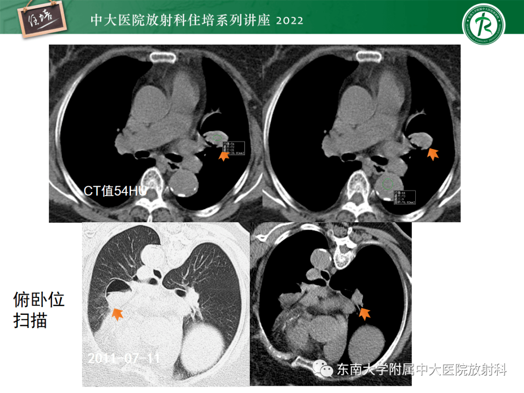 肺空腔,空洞性病变诊断分析思路_解剖图_全网_影像