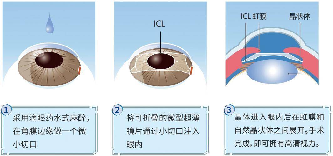 如果平时配戴隐形眼镜,术前需停戴软性隐形眼镜1周,硬性rgp需停戴1个