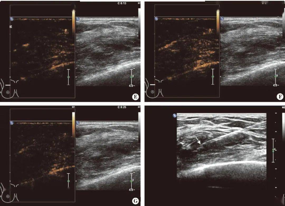 病例解析:胸壁软组织疾病超声诊断_回声_胸部_造影