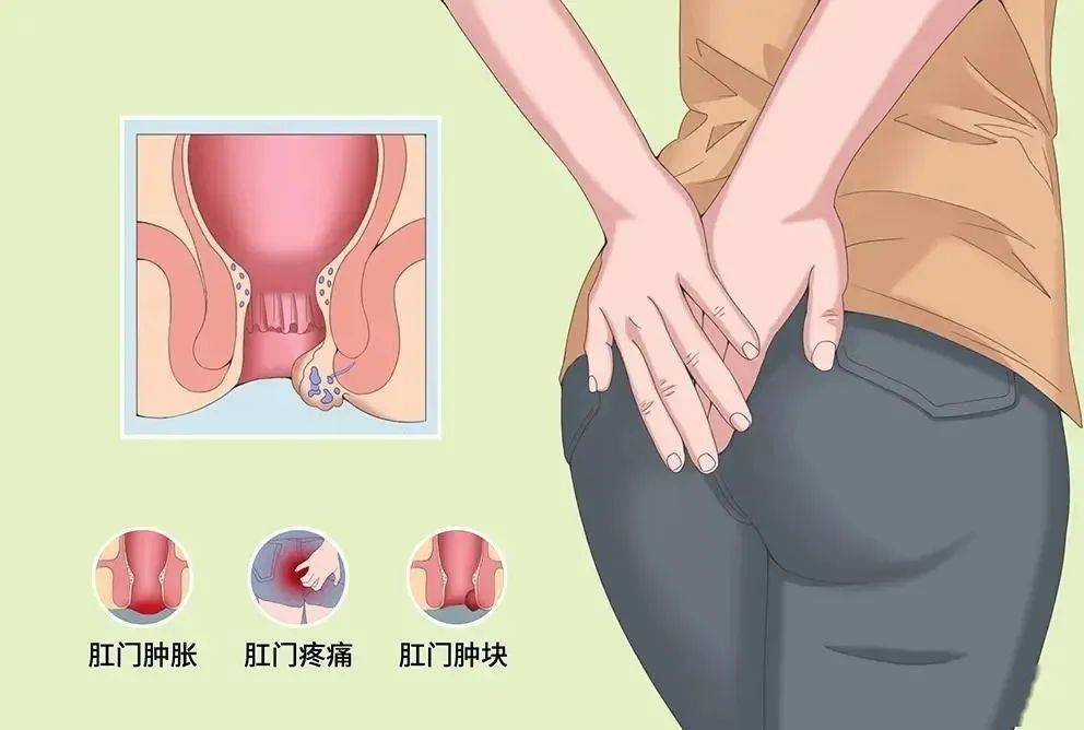肛门有这5个异常，肛瘘无疑了~