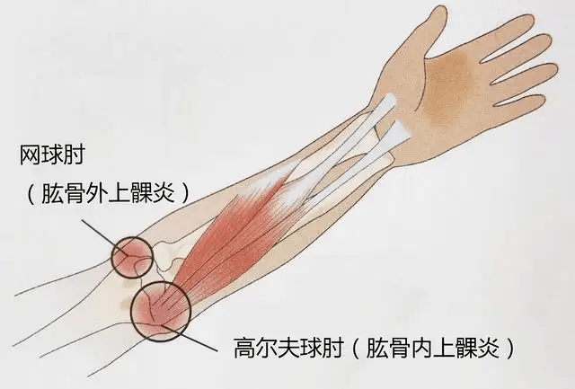 大部分是急性外伤,常见的有骨折,脱臼,韧带损伤,韧带断裂,肌肉撕裂等