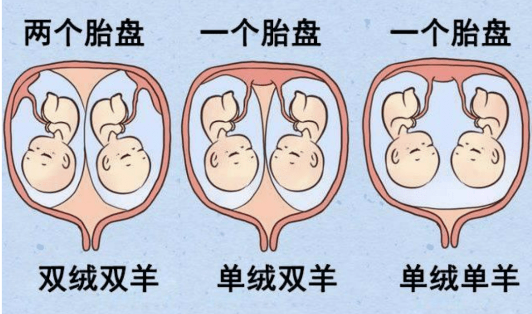 单绒单羊双胎(一)_胎儿_羊膜_超声