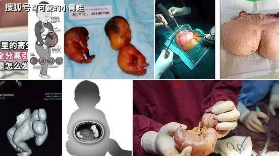 女婴体内有8个寄生胎