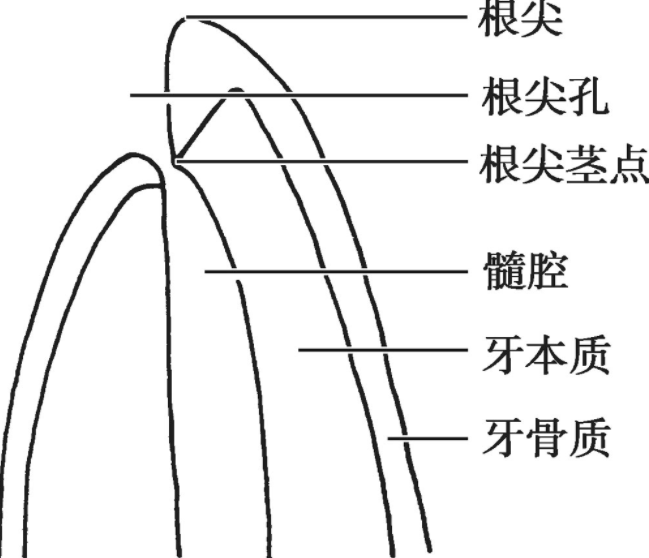 图16 根尖孔解剖随着年龄的变化,根尖区牙体组织不断沉积,根尖孔的