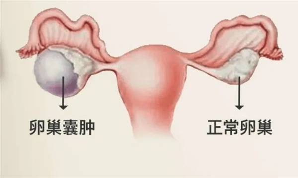 女子以为发胖肚中取出16斤囊肿？中医提醒卵巢健康需警惕！