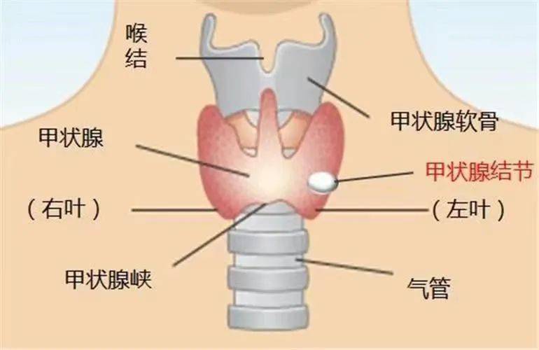 甲状腺结节