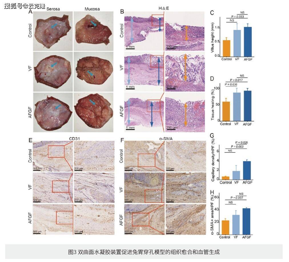 内镜下可递送和蘑菇帽启发的双曲面形载药生物粘附