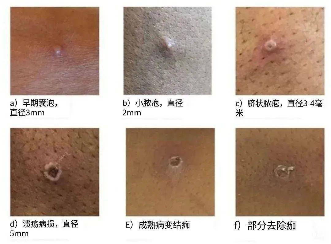 事关猴痘，广东疾控发布最新“八问八答”→