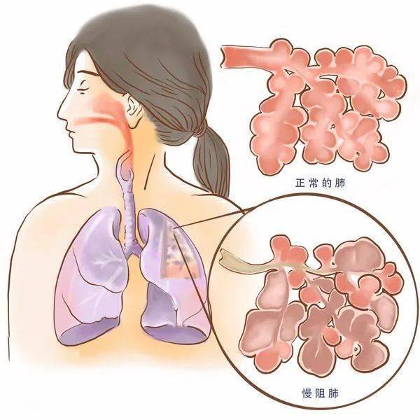 世界慢阻肺日|隐匿的呼吸杀手