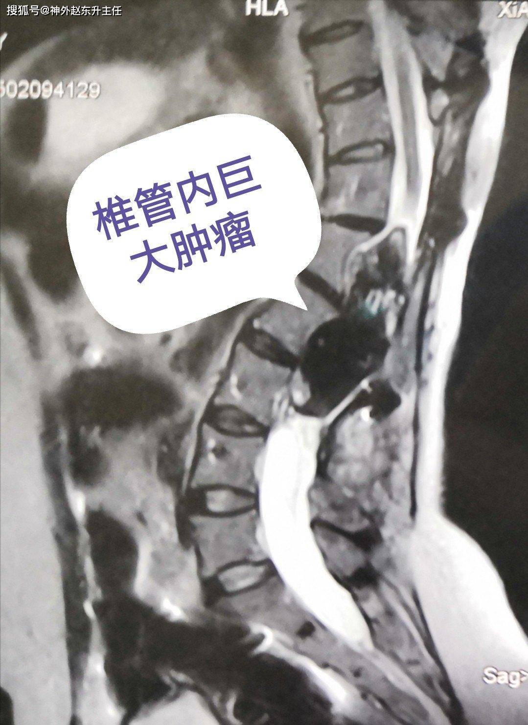 腰腿疼加重伴行走缓慢,原来是脊髓肿瘤复发了