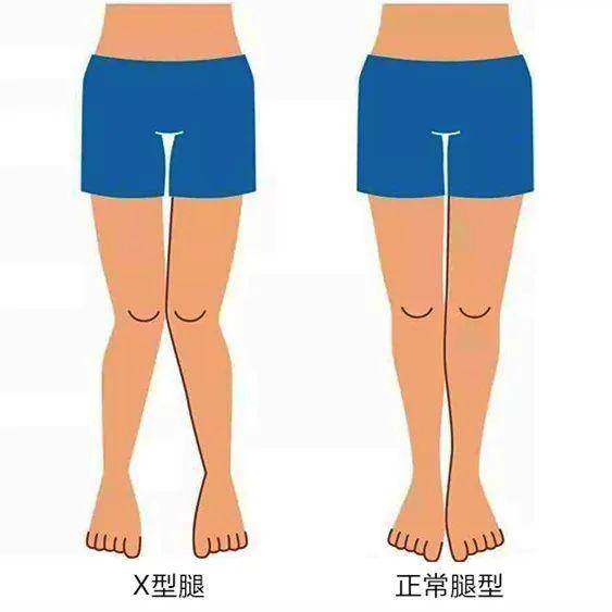 医学上称之为膝外翻,实质是由于股骨内收,内旋和胫骨外展,外旋所