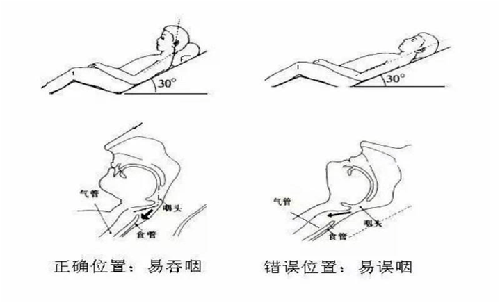 吞咽障碍自我康复训练小知识