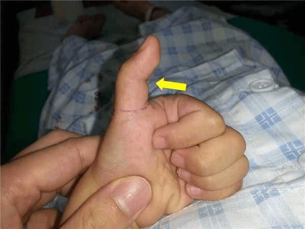 新生儿手指少关节图片图片