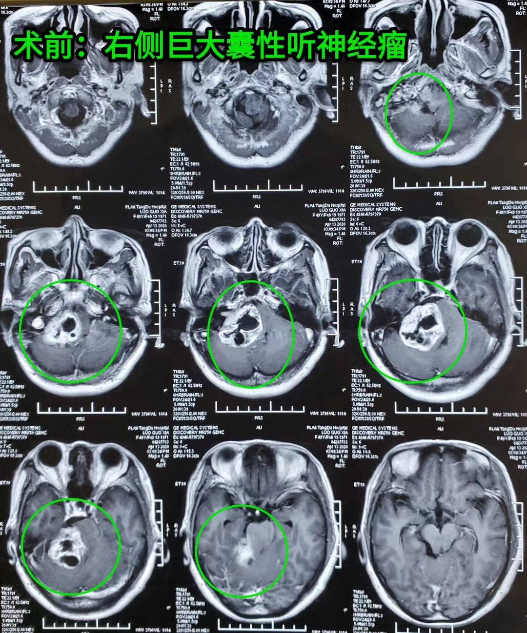 【病例分享】巨大囊性听神经瘤——唐都神经外科赵天智
