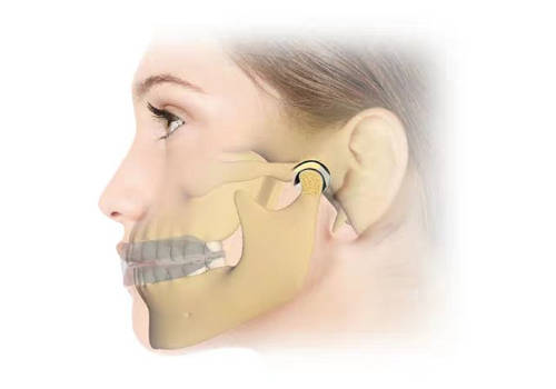 乔思牧颞下颌关节紊乱偏颌脸型打呼噜磨牙专用矫正器