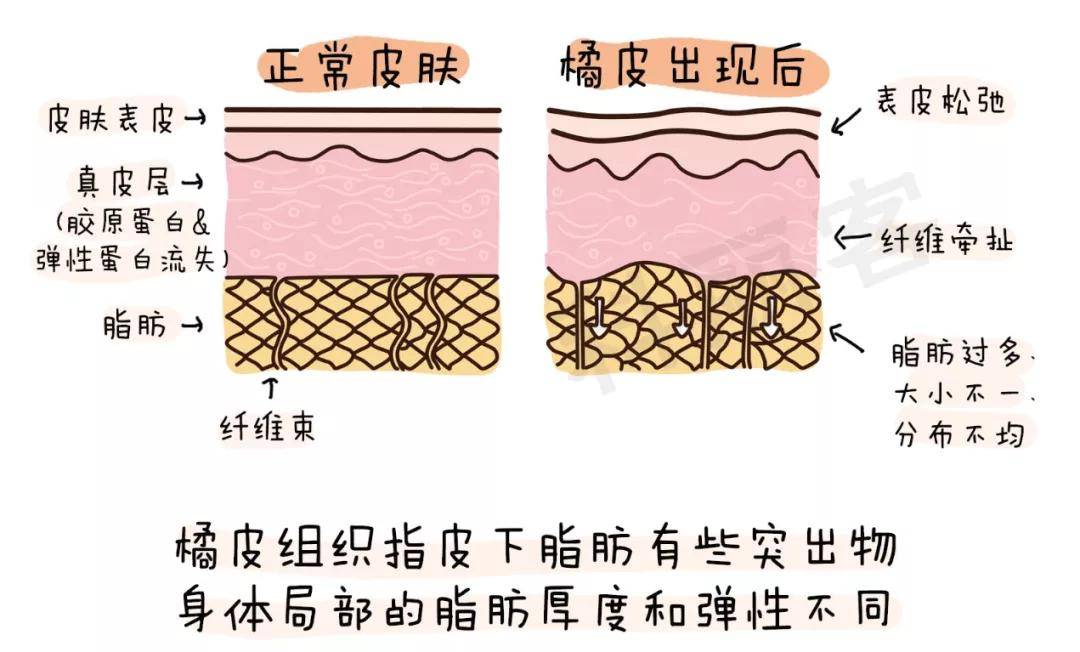 恆美網橘皮組織該怎麼消除