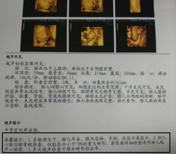 原创同样是怀孕,为啥单胎需要做唐氏筛查和四维彩超?而双胎没必要做