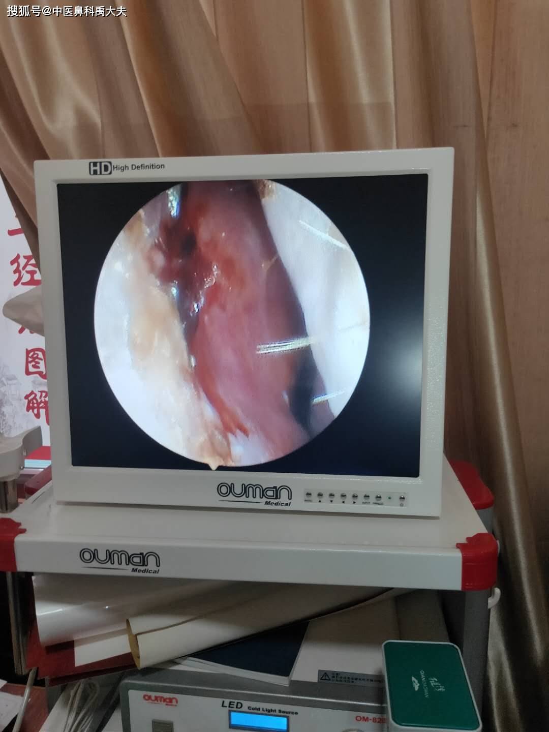 鼻出血你了解吗?_鼻腔