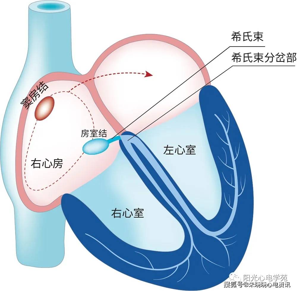 ③特征:心动过速的发作和心房,房室结传导无关.