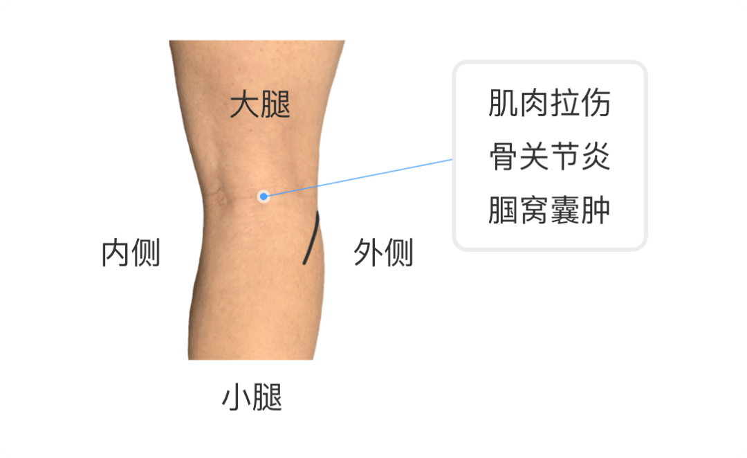 圖片來源:京醫通原創疼痛位置:如果在膝蓋窩疼痛,則可能是肌肉拉傷