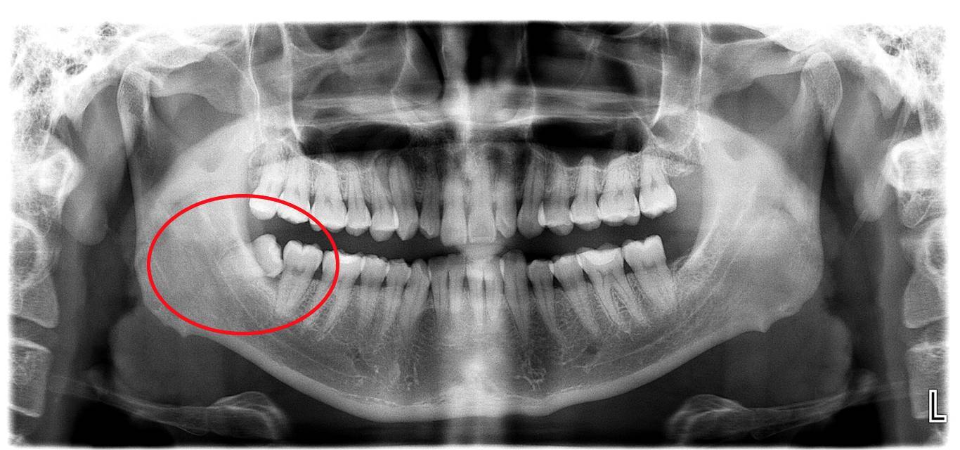 赶紧来一个口腔检查,拍一个口腔全景片吧,不仅可以了解你的全面口腔